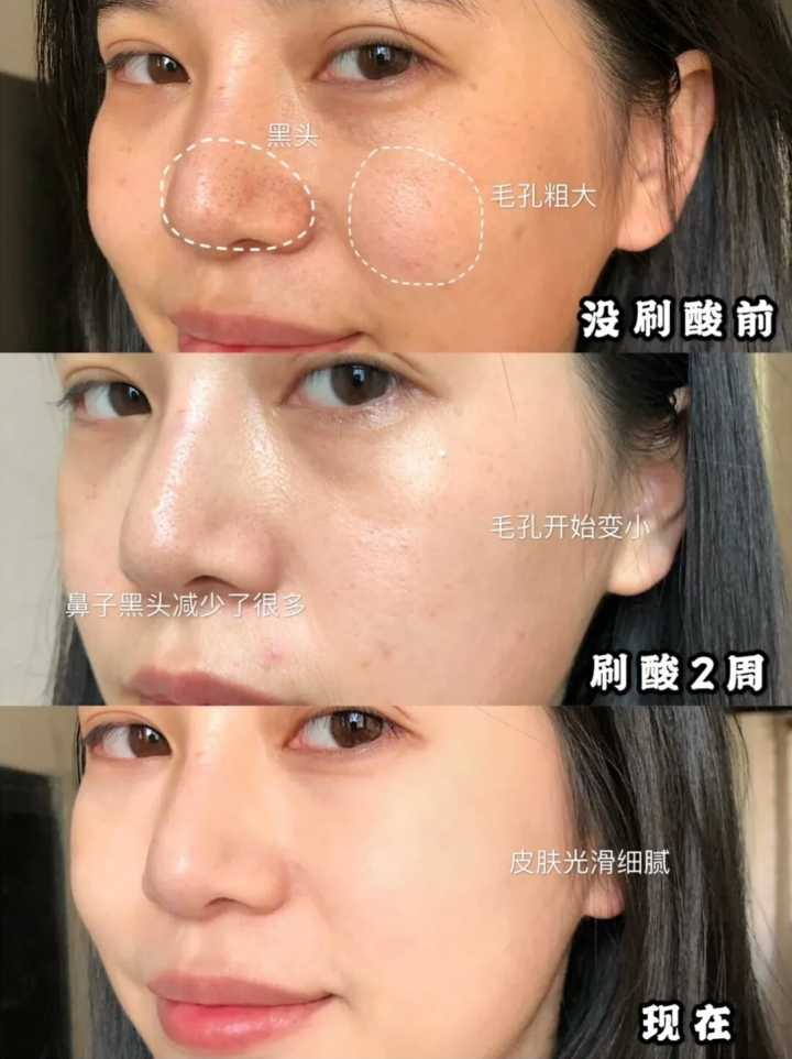 乌龙事件,在家刷酸烂烂烂脸了