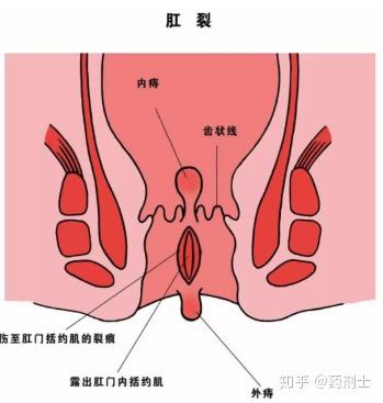肛裂的症状 - 知乎