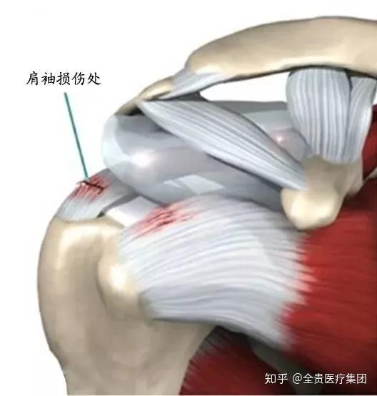 3钙化性冈上肌肌腱炎