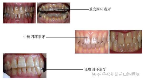 郑州 四环素牙是什么样子的图片?精益口腔图片示例