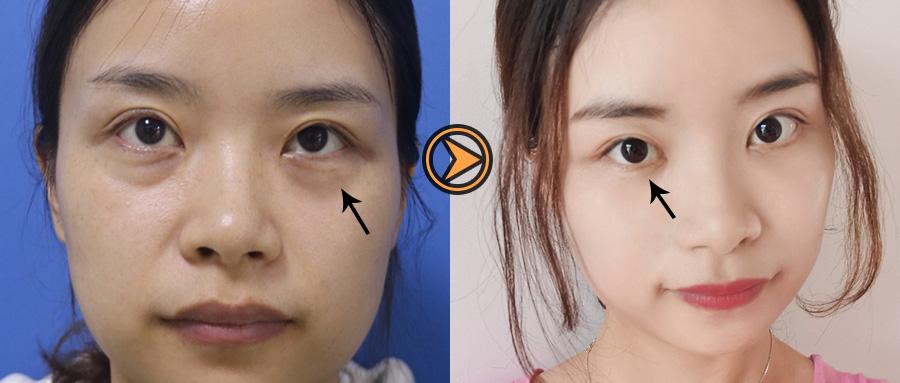女人有眼袋和没眼袋区别,看完这个案例你就明白了
