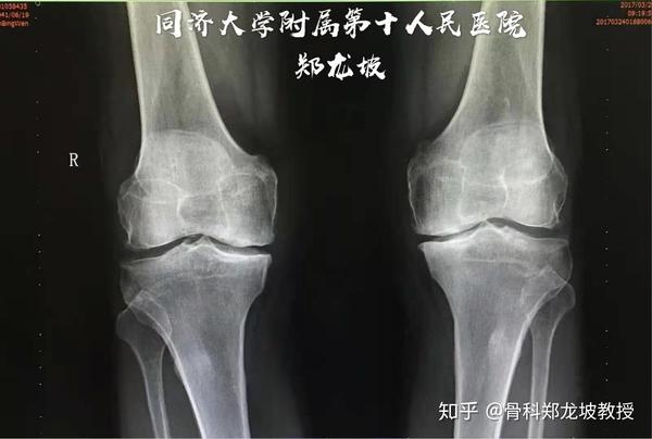 双膝骨关节炎分期行膝关节表置换术