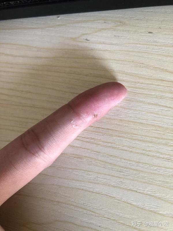 画圈才是长瘊子的地方,目前肉里面摸上去没有硬硬的,感觉和其他的皮肤