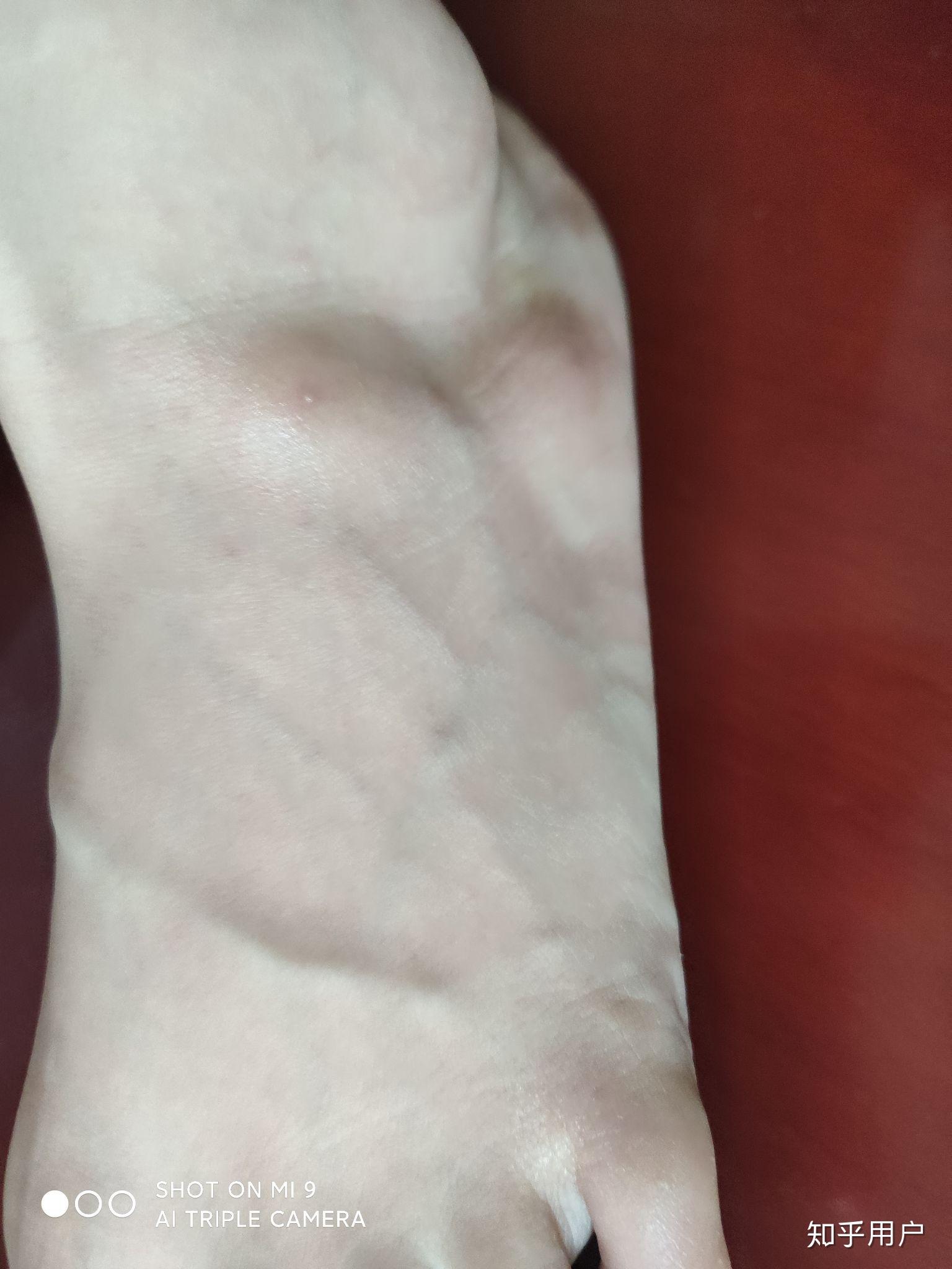 被蚂蚁咬了伤口周围有硬物感中间还有个小泡今天是第三天了还没好怎么