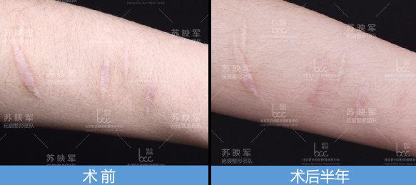 白色疤痕如何才能恢复正常肤色
