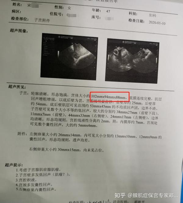 案例详解:曼月乐,达菲林对于腺肌症的现实作用