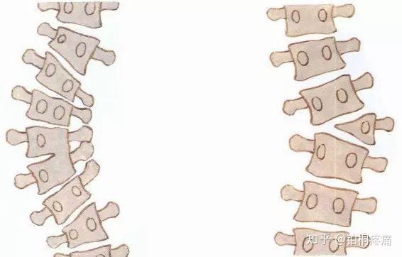 生长发育期间 原因不清的脊柱侧弯称为 特发性脊柱侧弯,根据发病年龄