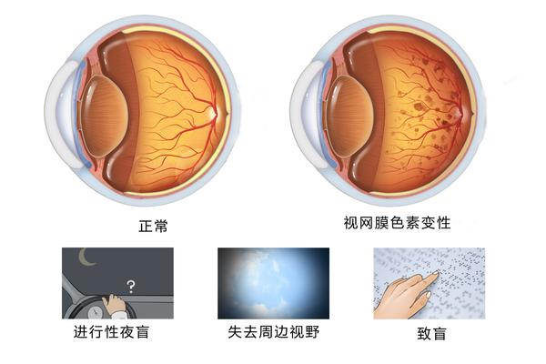 视网膜色素变性