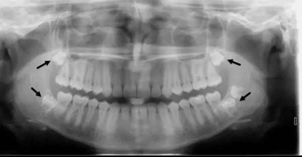 智齿,医生口中的第三磨牙,阻生齿,患者口中的立事牙,是口腔中最后一颗