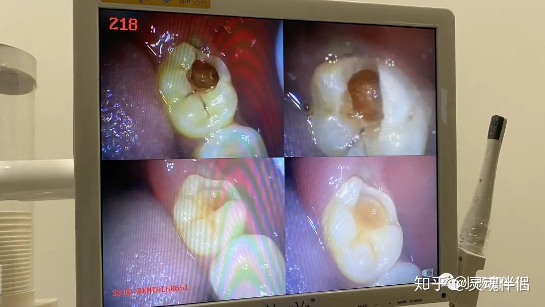 我的两颗深度龋齿的治疗经历