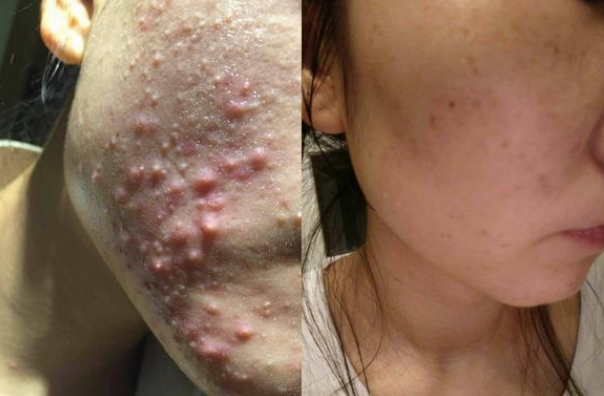 慎入最严重的痘痘长什么样针对不同的皮肤给予最好的建议