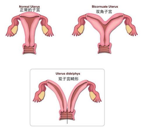 18岁少女竟有两子宫一月流两次血甚至能边怀孕边来月经