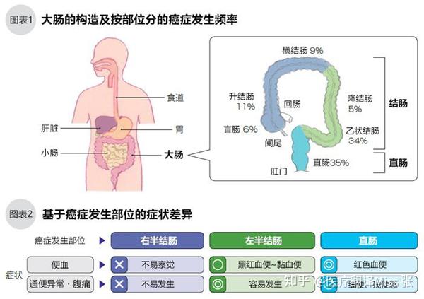 结直肠癌的症状
