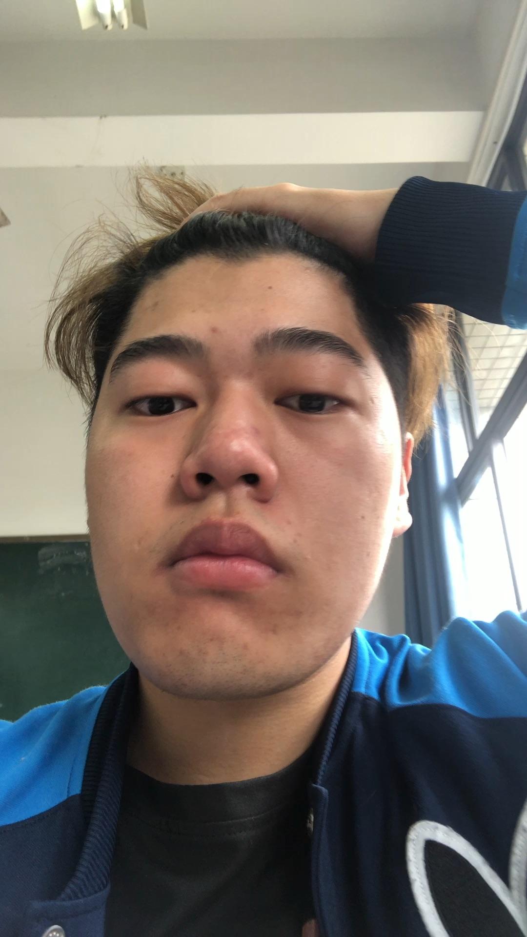 偏颌脸歪要怎么整?