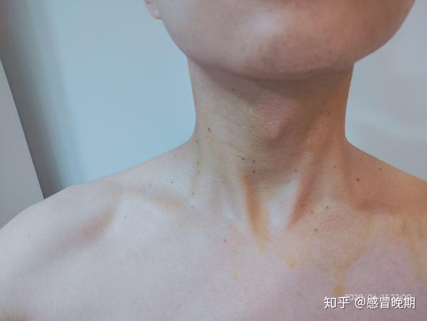 脖子上丝状疣治疗日志