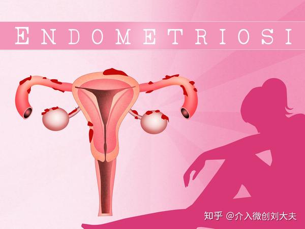 子宫腺肌症的临床分型与治疗方式