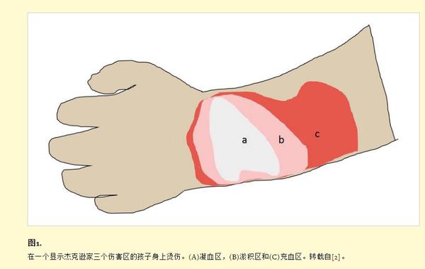 一个孩子的烫伤显示出杰克逊烧伤分级的三个损伤区域.