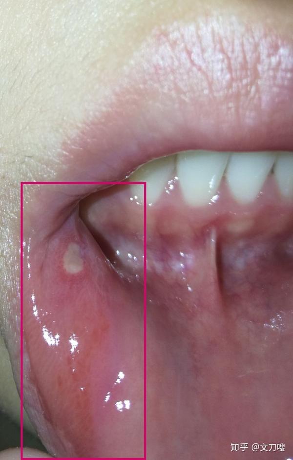 口腔溃疡我喷的霜,不疼了但是四个小时后嘴有点肿,而且越来越肿?