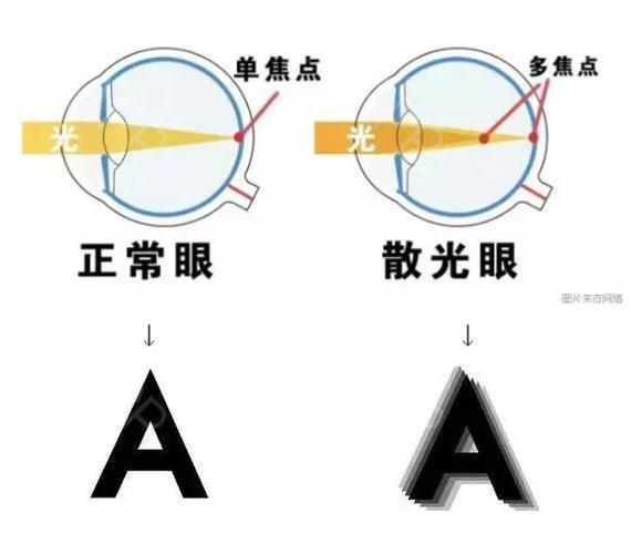 这几种人,验光必须要做散瞳!