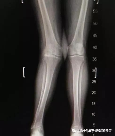 股骨远端闭合截骨dfo治疗严重膝外翻畸形