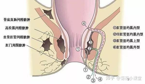 直肠肛门部有三大常见疾病:痔疮,肛瘘和肛裂.