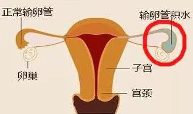 怎么发现自己输卵管积水?