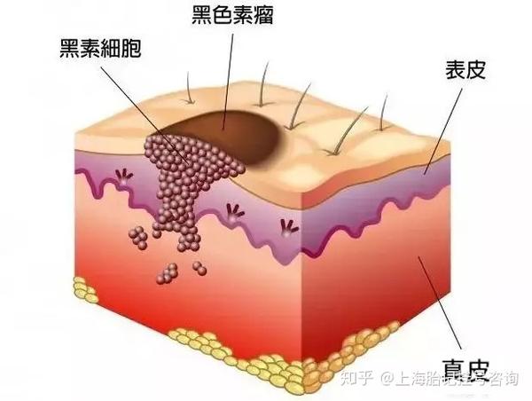 小孩黑胎记形成的原因