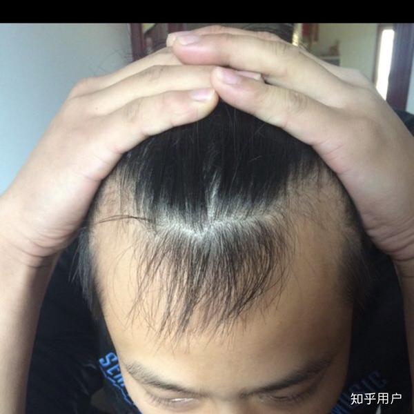 头发掉成这样用米诺地尔有用吗?
