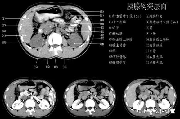 胰腺钩突层面