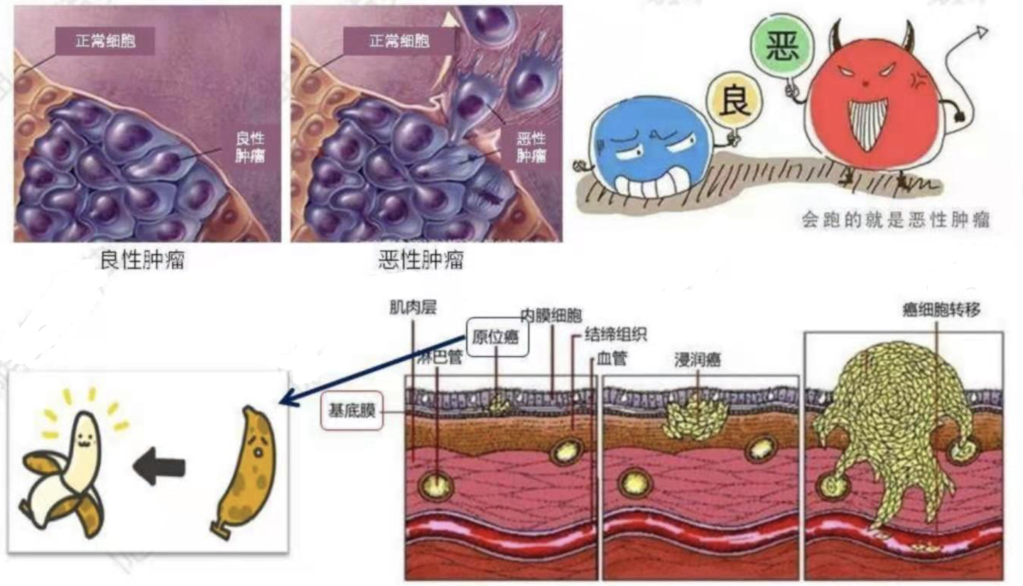 癌症知识:肿瘤,恶性肿瘤和癌症