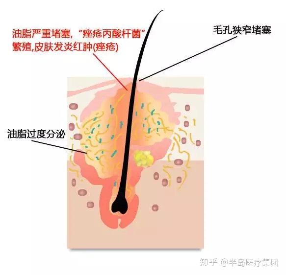 三,痤疮丙酸杆菌和炎症反应