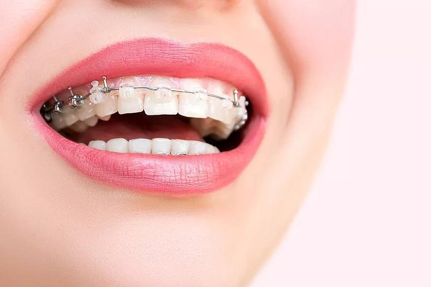 福州牙齿矫正正畸金属陶瓷隐形舌侧哪种牙套比较好费用各是多少怎么选