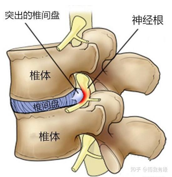 腰椎间盘突:腰部固定,给腰一个支撑,症状就会改变!