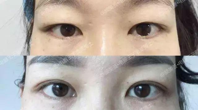 潘贰:双眼皮/双眼皮手术科普:眼皮厚,眼睛肿的原因是?