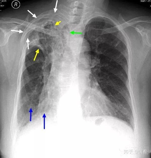 肺纤维化病变影:陈旧性肺结核.
