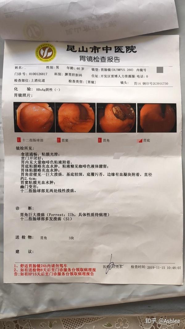 胃低分化腺癌 - 知乎