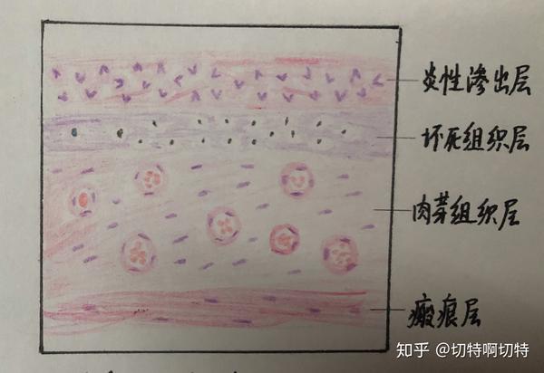 2.肝脂肪变 有脂滴