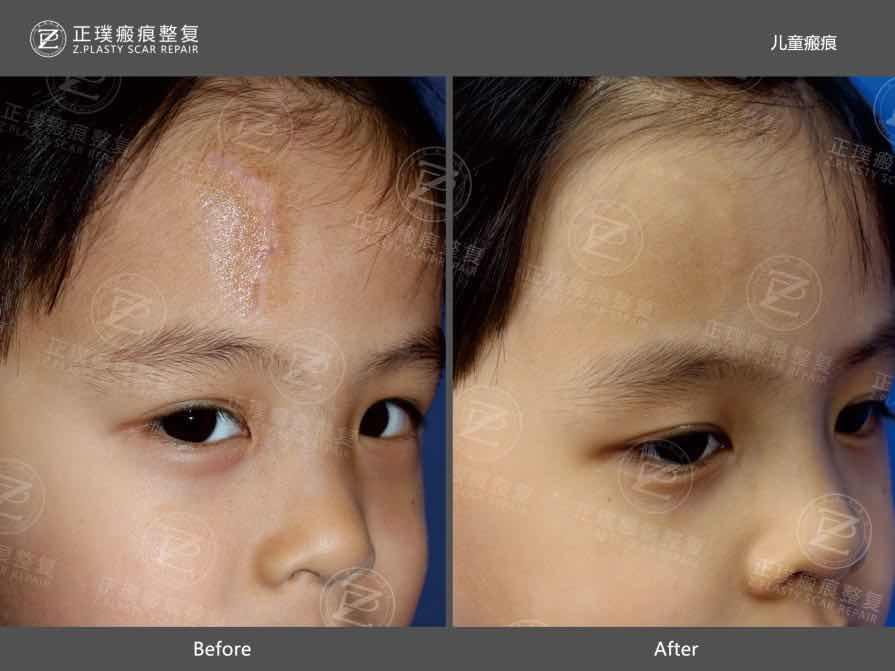 正璞瘢痕:儿童疤痕治疗为什么难度大?