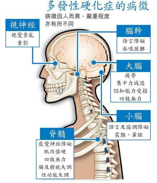 逆转多发性硬化症干细胞志在必得