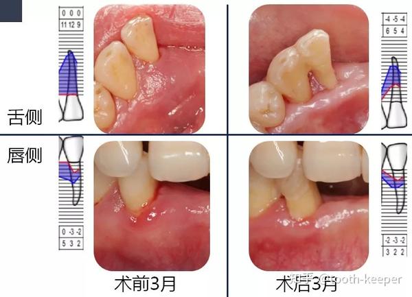 药物性牙龈肥大序列治疗一例