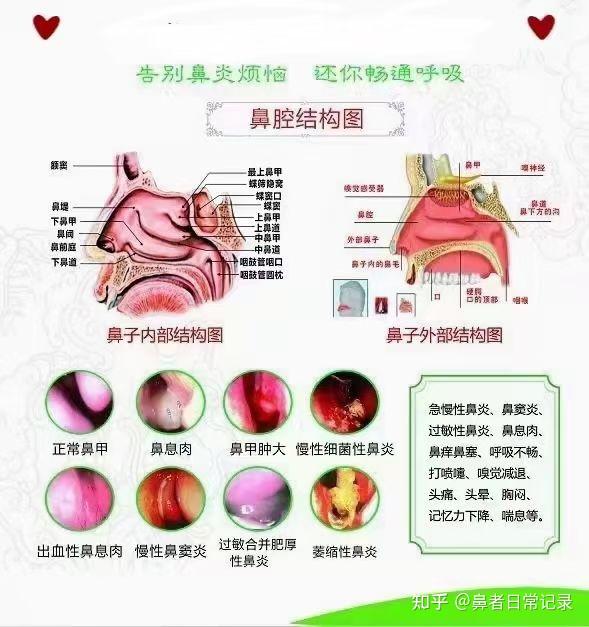 鼻甲肥大引起鼻塞有哪些特点