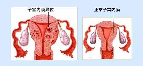 子宫内膜异位症它会导致不孕吗