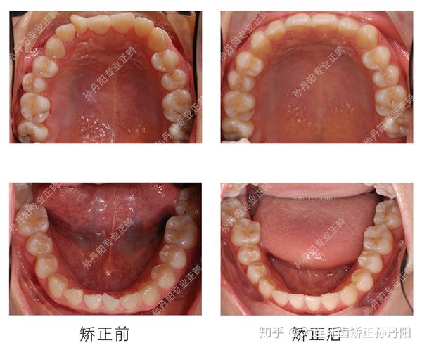 大连舌侧矫正拔除左上门牙与侧切牙间的多生牙矫治牙齿拥挤