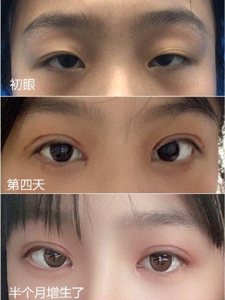 广州割双眼皮医生那个好?双眼皮修复医生推荐?(黑料篇