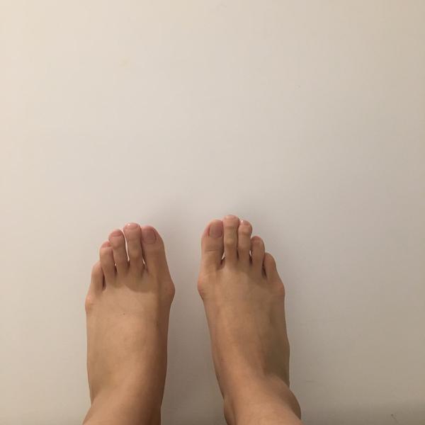 女生脚趾拇外翻是什么样体验?