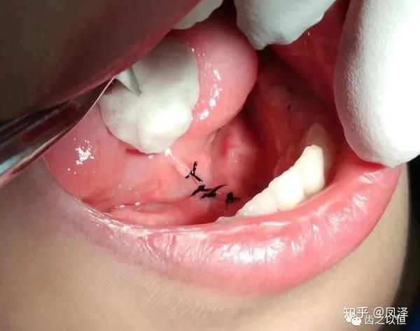 临床小窍门:舌系带延长术这样做,非常安全.