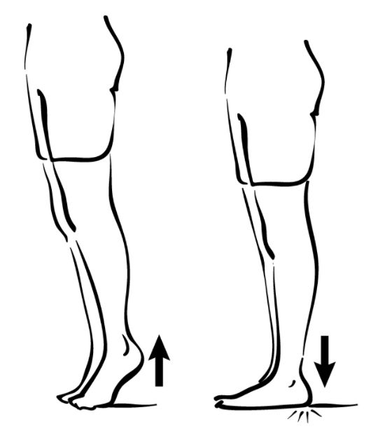 扁平足是xo型腿造成的吗xo型腿和扁平足都会使跑步时膝盖受到影响吗