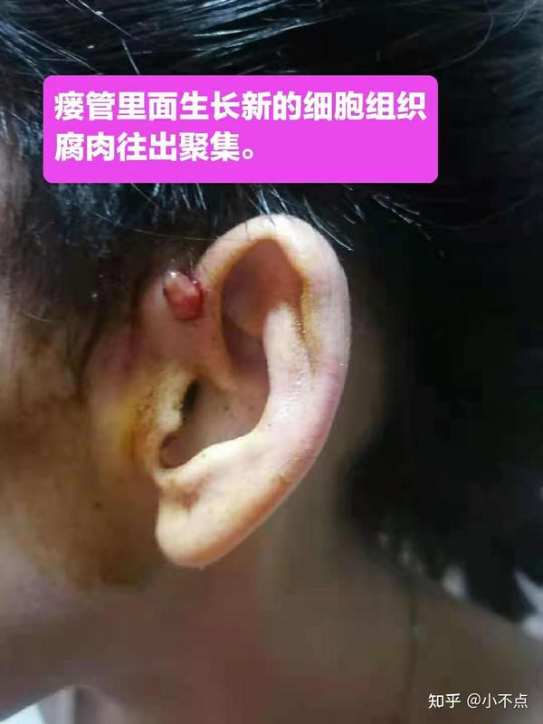 耳前瘘管让我犯了难老北鼻