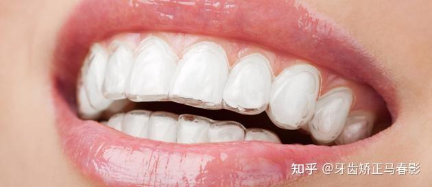 隐形牙套和钢牙有什么区别呢?