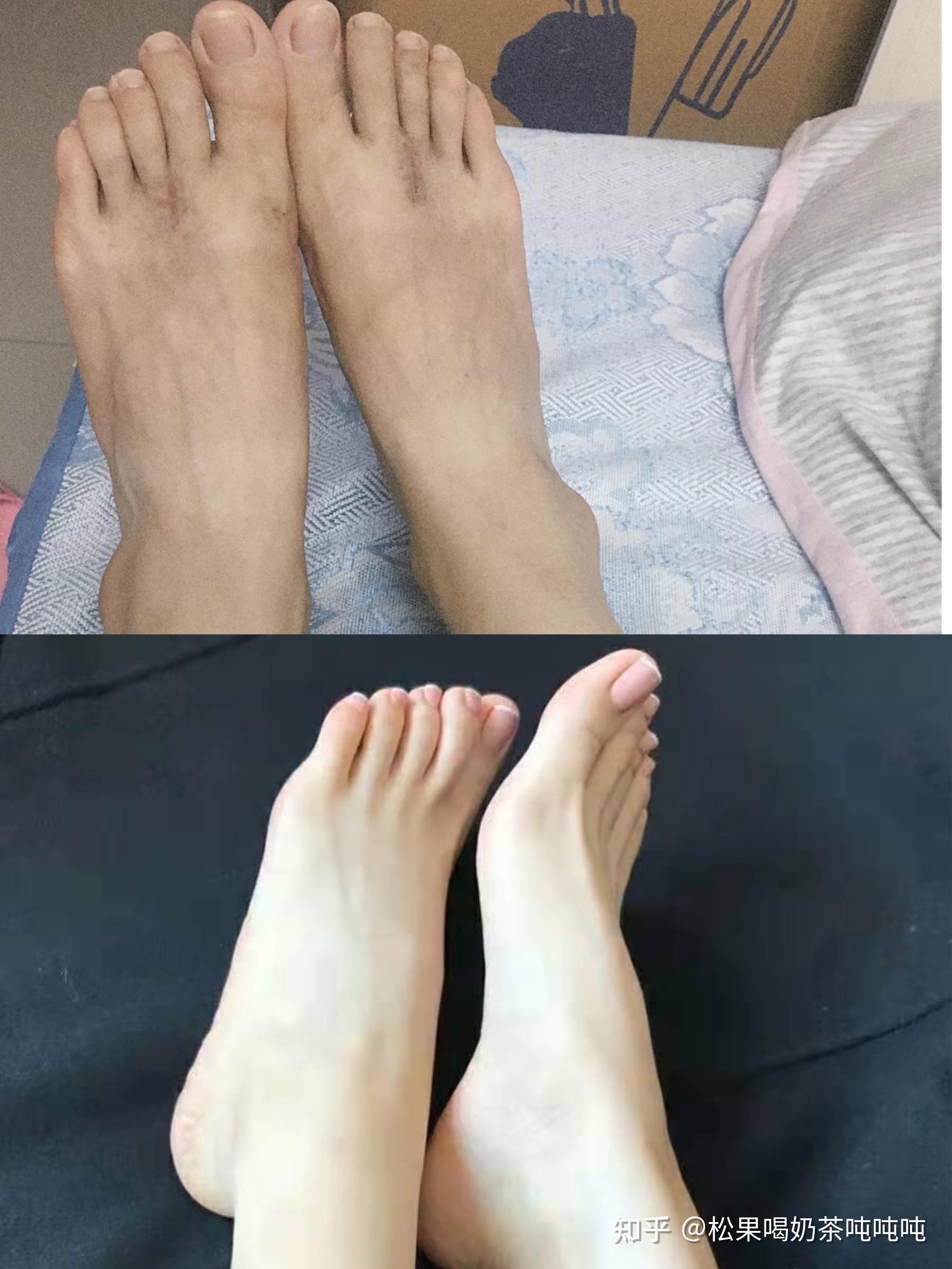 如何让脚变白变嫩